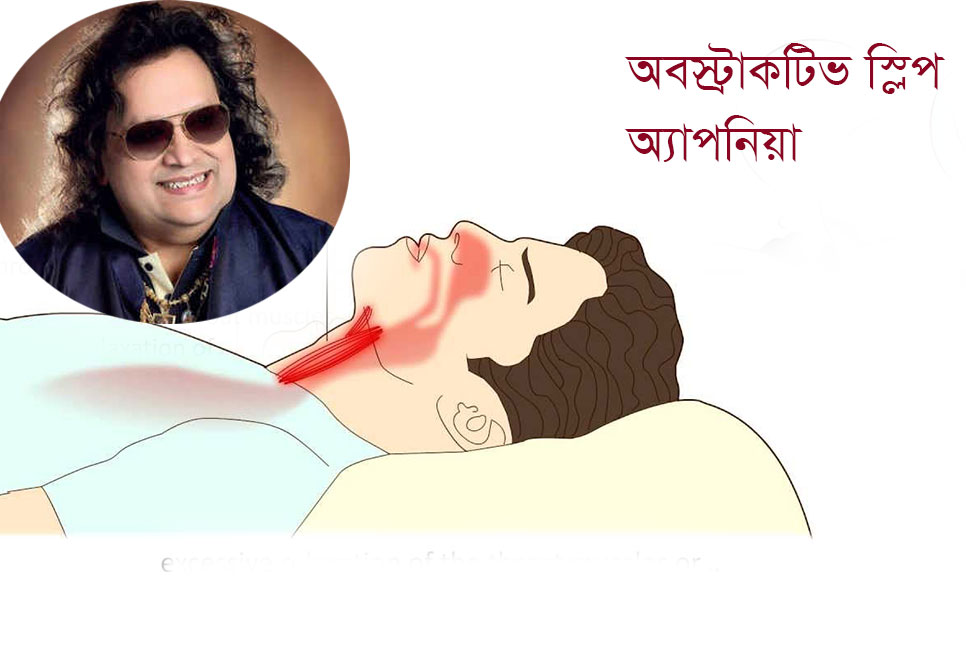 অবসট্রাক্টিভ স্লিপ অ্যাপনিয়া কী? জেনে নিন লক্ষণসমূহ